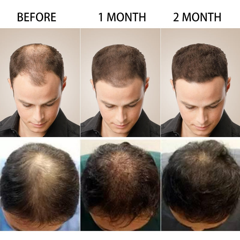 Ginger Hair Growth Product/Hair Loss Oil-Scalp Treatment